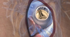 Nahtlose Aortenklappe 3